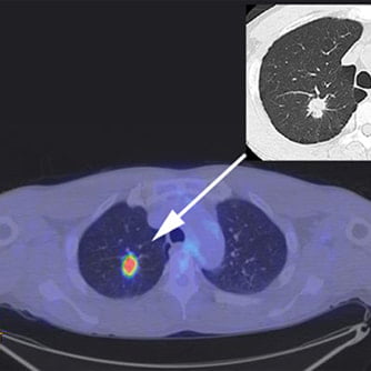 症例1 胸部PET/CT