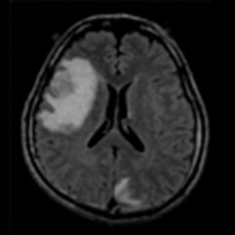 症例1 頭部MRI