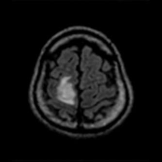 症例1 頭部MRI