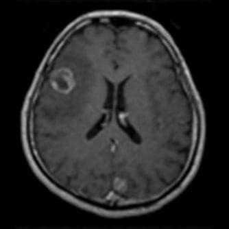 症例1 頭部MRI