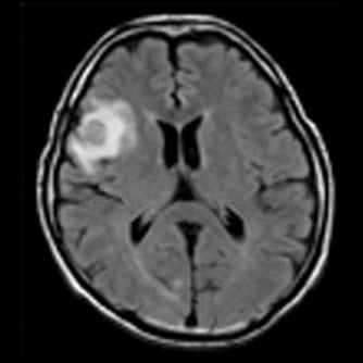 症例1 頭部MRI