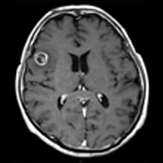 症例1 頭部MRI