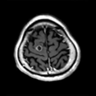 症例1 頭部MRI