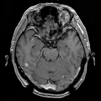 症例1 頭部MRI