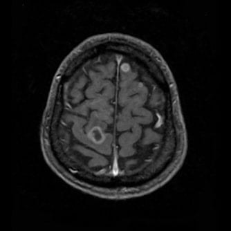 症例1 頭部MRI