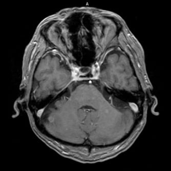 症例1 頭部MRI