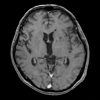 症例1 頭部MRI