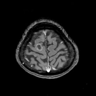 症例1 頭部MRI