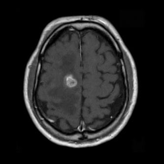 症例2 頭部MRI