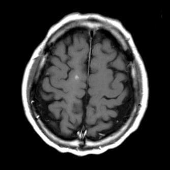 症例2 頭部MRI