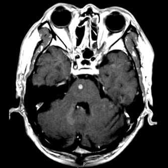 症例2 頭部MRI