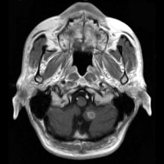 症例2 頭部MRI