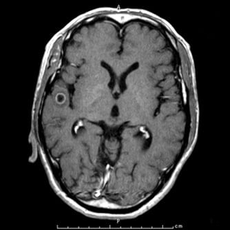 症例2 頭部MRI