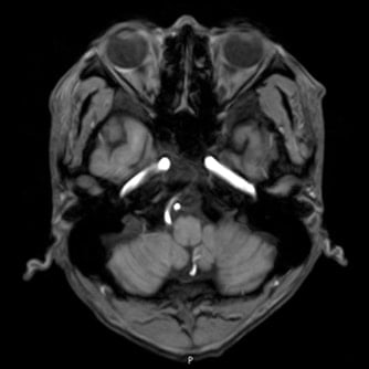 症例2 頭部MRI