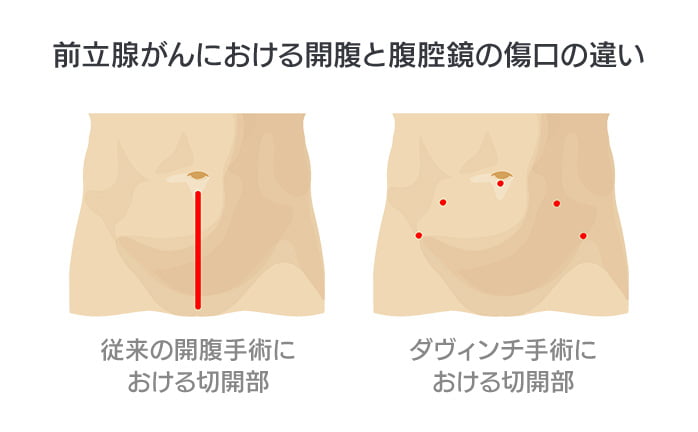 前立腺がんにおける開腹と腹腔鏡の傷口の違い