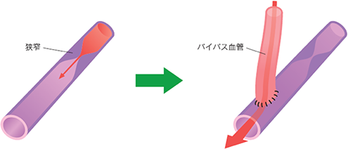 心拍動下冠動脈バイパス術のイメージ図2