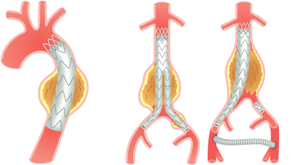 ステントグラフト内挿術のイメージ図