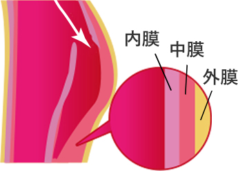 解離性大動脈瘤（大動脈解離）