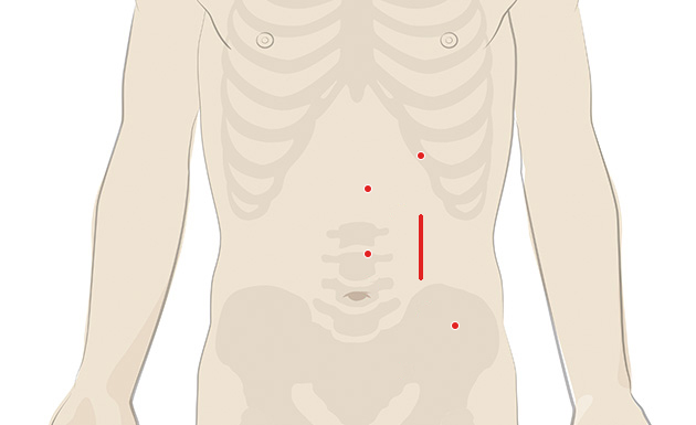ダヴィンチ手術における切開部