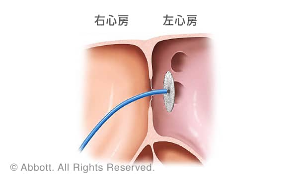 卵円孔開存部を通過させて左心房側で一方のディスクを展開します。