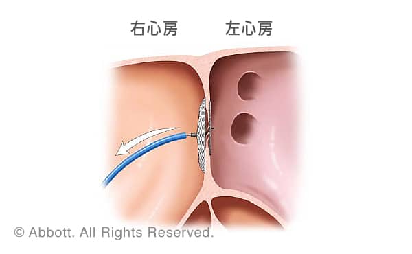 続いてデリバリーカテーテルを右心房側に移動させて、もう一方のディスクを展開することにより卵円孔開存（PFO）を閉鎖する治療法です。