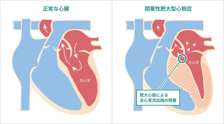 正常な心臓/閉塞性肥大型心筋症