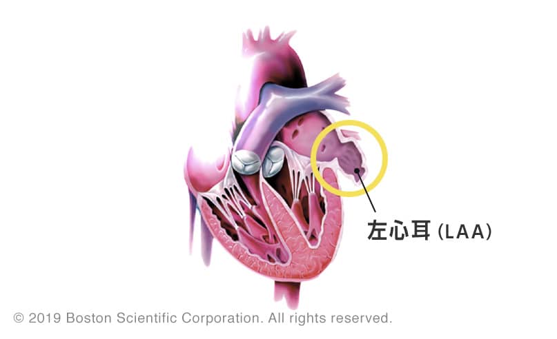 左心耳閉鎖システム（LAA）の位置イメージ