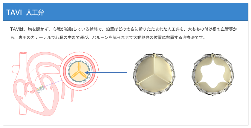 TAVI人工弁