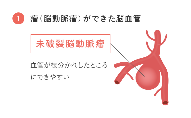 瘤（脳動脈瘤）ができた脳血管の図