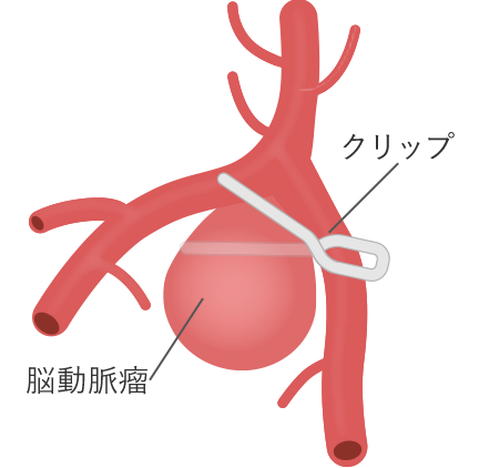 脳動脈瘤の首を金属製のクリップで挟むイラスト