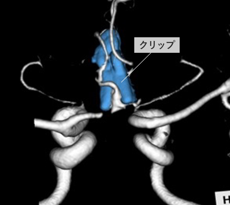 脳動脈瘤のクリッピングによる治療後の写真