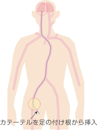 大腿動脈からカテーテルを挿入するイラスト
