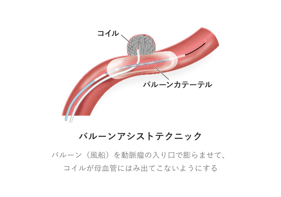 バルーンアシストテクニック