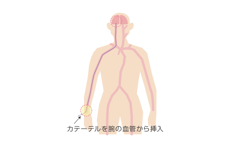 カテーテルを腕の血管から挿入する場合のイラスト