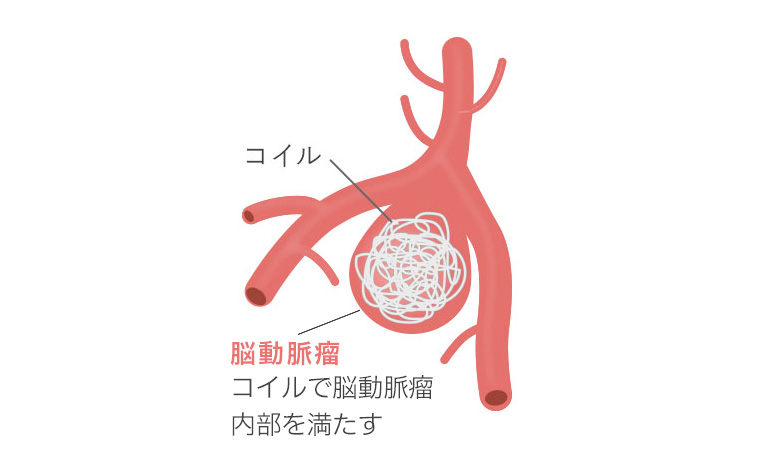 血管内治療（コイル塞栓術）の治療方イラスト